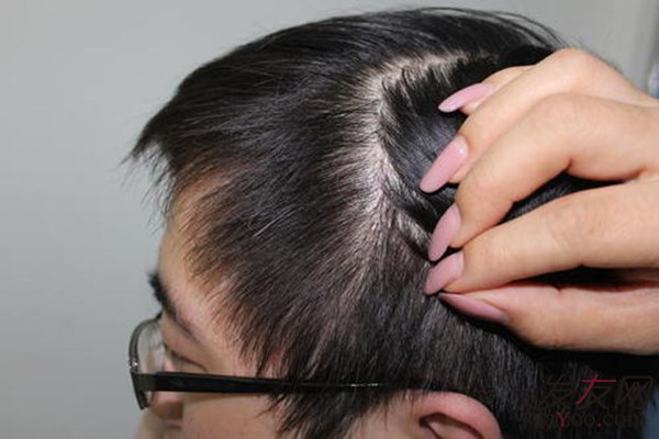 做完植发手术后头发效果如何保证?