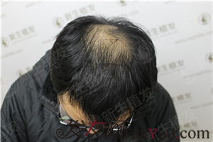 术前照片郭先生是属于四级脱发的,从图片可以看出头顶那一块的脱发