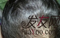 北京雍禾植发，还没有去