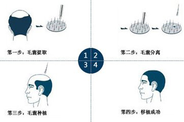 植发的步骤都有什么？　