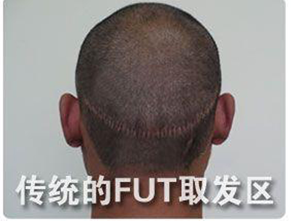 FUT是什么植发技术效果怎么样？　