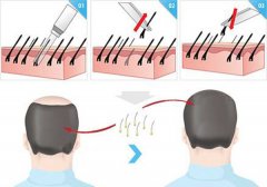 植发你想了解什么？