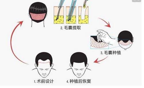 植发都需要知道什么？　