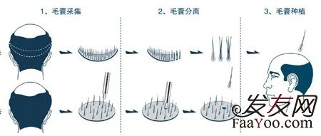 植发到底怎么样效果？　