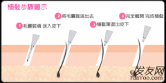 植发的成功率到底怎么样？