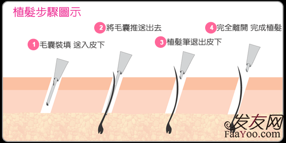 植发的成功率到底怎么样？　