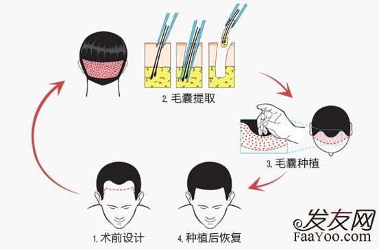 王宇讲解：植发技术现在分别有几种？　