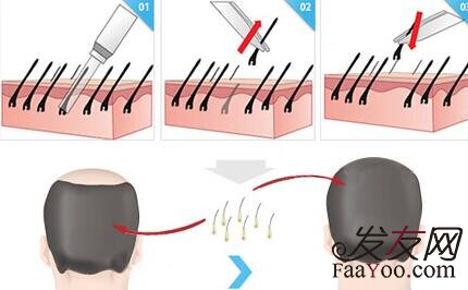 植发都需要了解什么？你们知道吗？　