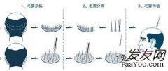 植发你真的都清楚了解吗？