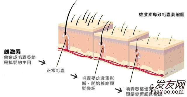 DHT与脱发的关系