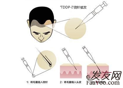 fue植发和微针植发一样吗？