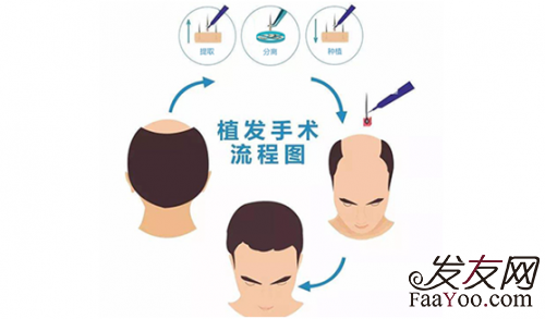 fue植发和微针植发一样吗？