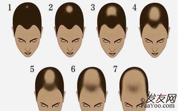 男性脱发主要分为7个级别,一级脱发发际线完全正常或轻度后移,一般