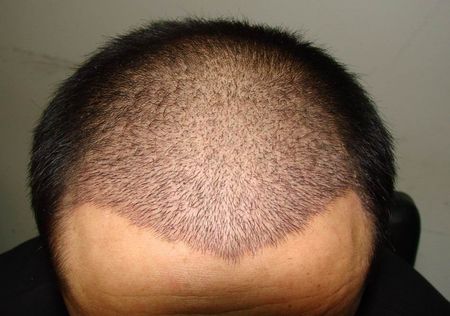 的脱发治疗新技术,它采用自体毛发移植原理种出来的头发永久不掉落