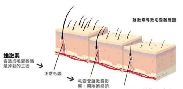 应该要怎么缓解雄性脱发