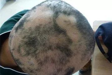 斑秃是一种局限性斑片状脱发,表现为头部圆形或椭圆形,多为头皮光滑