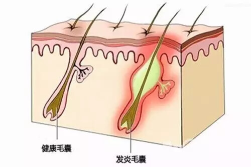 毛囊不够还可以去植发吗