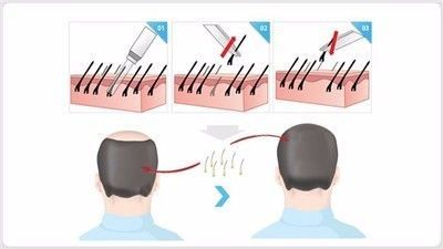 常见的植发技术