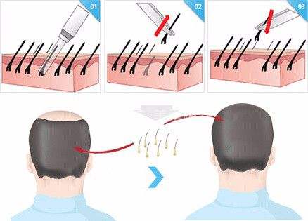 植发手术常见的问题