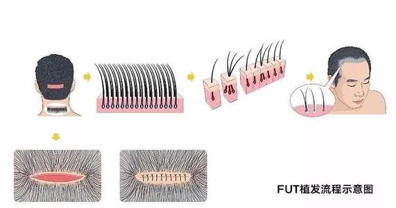 植发FUT和FUE的区别|哪一个效果更好