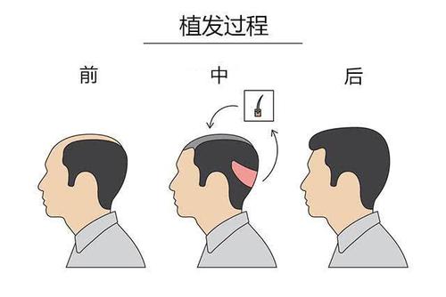 怎么判断疤痕处是否能够植发