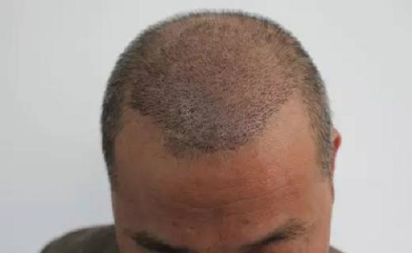 植发后会有哪些后遗症